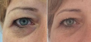 cieniepod oczami przed i po 5 zabiegach Fenix